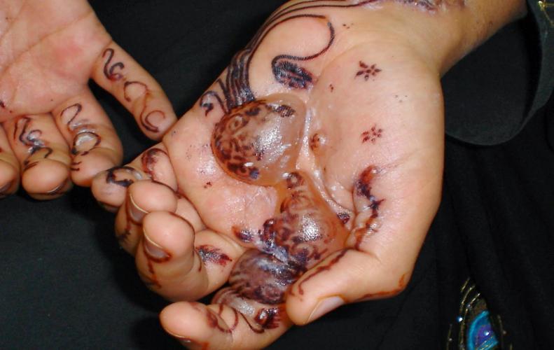 Chemical Mehndi Can Even Burn Your Hand ( it can cause skin cancer)